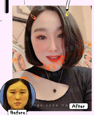 王會(huì)勇鼻綜合案例