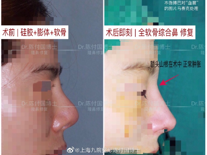 陳付國(guó)鼻綜合案例