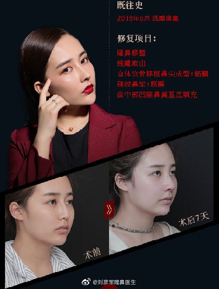 劉彥軍鼻修復(fù)案例