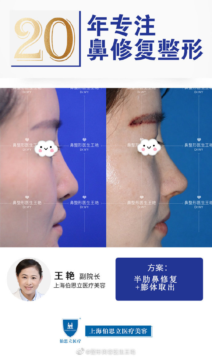 王艷鼻修復(fù)案例