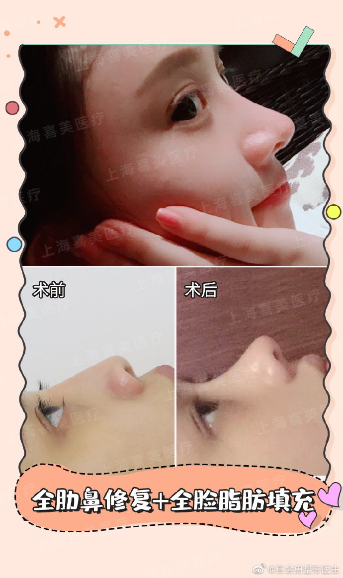 王會勇鼻修復(fù)案例