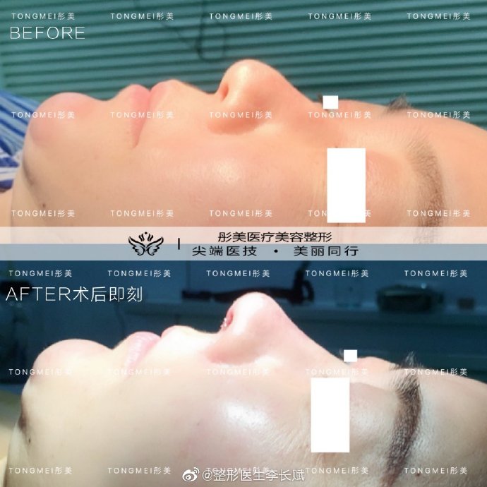 李長(zhǎng)賦鼻綜合