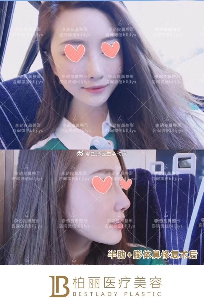 李勁良鼻綜合案例
