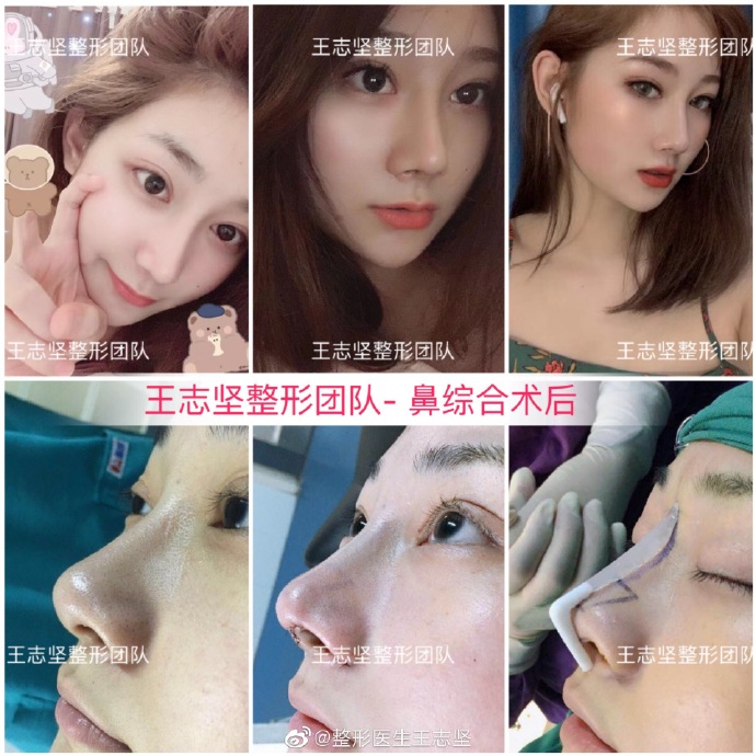 王志堅(jiān)鼻綜合案例