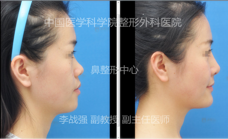 李戰(zhàn)強(qiáng)鼻修復(fù)案例