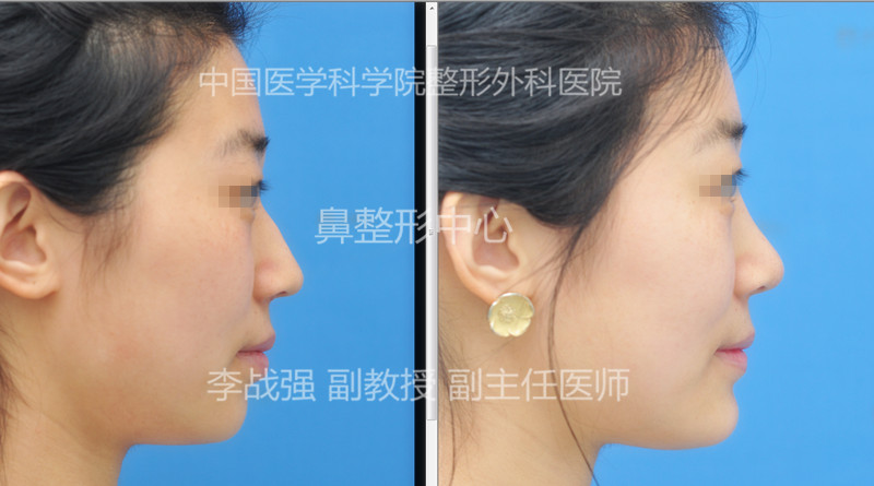 李戰(zhàn)強(qiáng)鼻修復(fù)案例