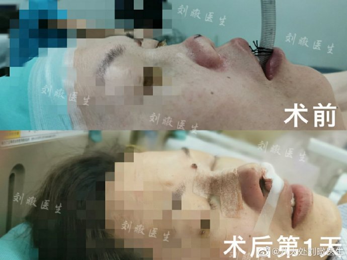 劉暾鼻修復(fù)案例