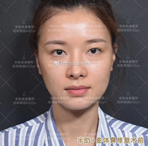 李勁良鼻修復(fù)案例