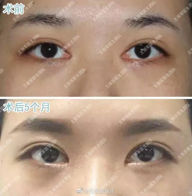 王振軍雙眼皮修復(fù)案例