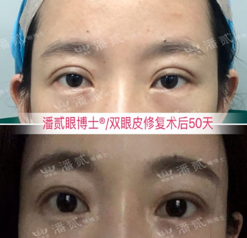 潘貳雙眼皮修復案例