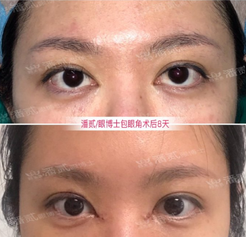 潘貳雙眼皮修復案例