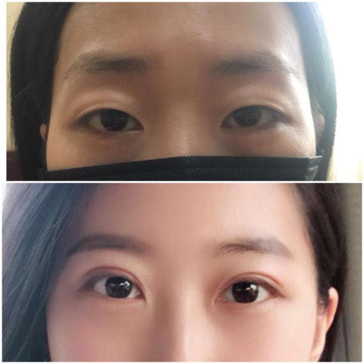 王世勇和田國靜哪個修復雙眼皮好？