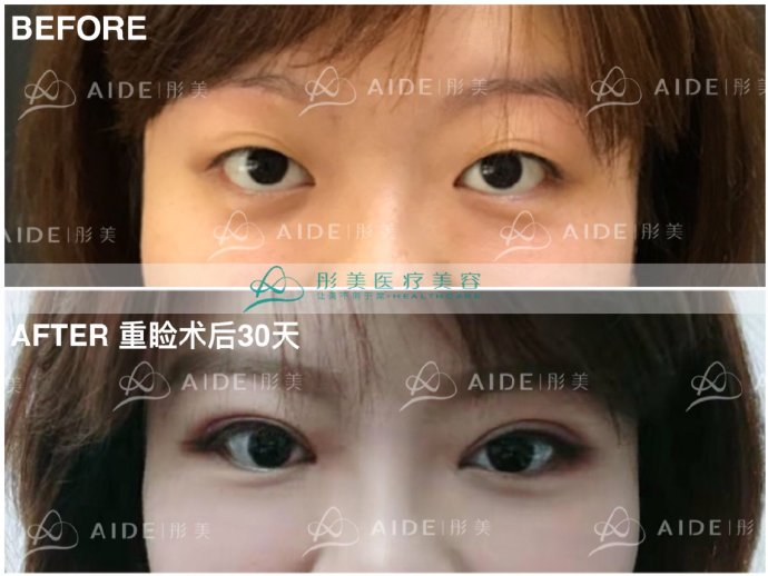 劉風卓雙眼皮案例
