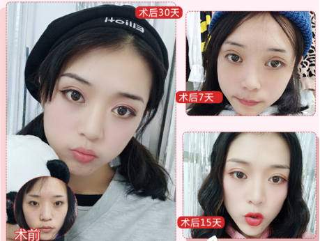 北京公立三甲醫(yī)院割雙眼皮醫(yī)生