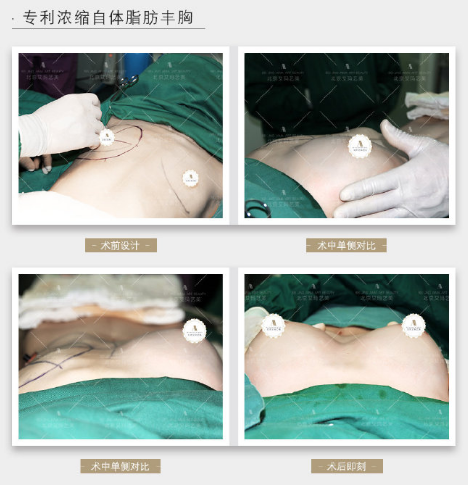 韋元強脂肪豐胸案例