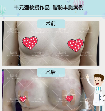 韋元強脂肪豐胸案例