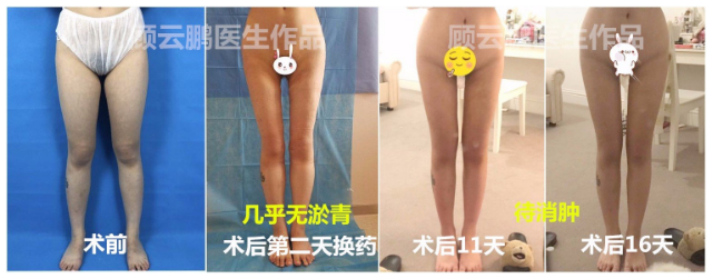 顧云鵬大腿吸脂案例
