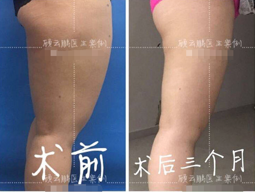 顧云鵬大腿吸脂案例