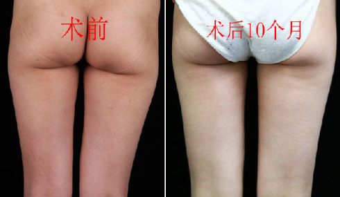 李發(fā)成大腿吸脂案例