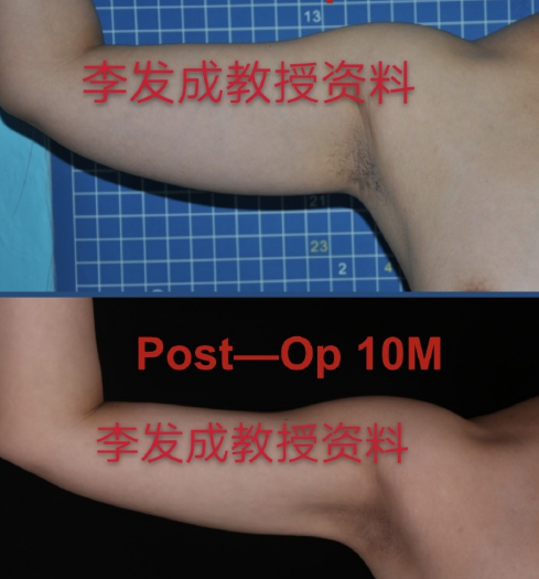 李發(fā)成吸脂案例
