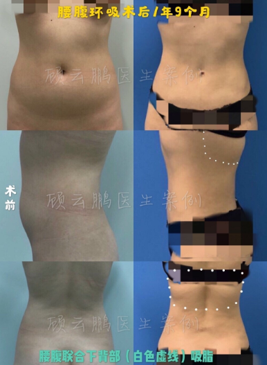 顧云鵬腰腹環(huán)吸案例