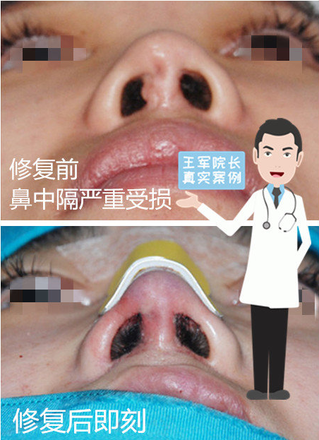王軍鼻修復(fù)案例1