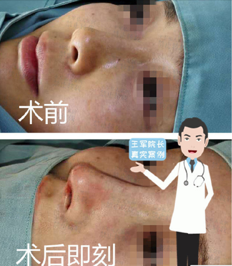 王軍鼻整形愛(ài)那里