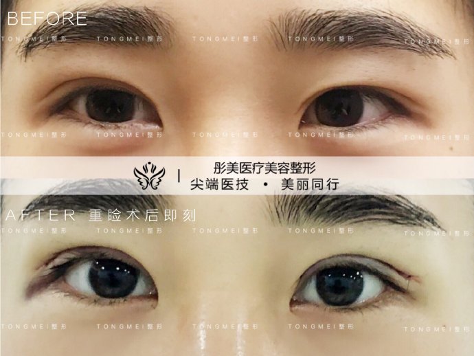 劉風卓雙眼皮修復案例