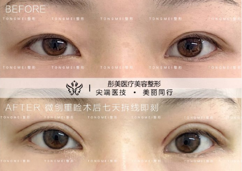 劉風卓眼綜合案例