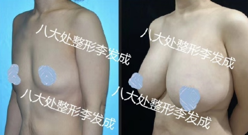 李發(fā)成豐胸案例