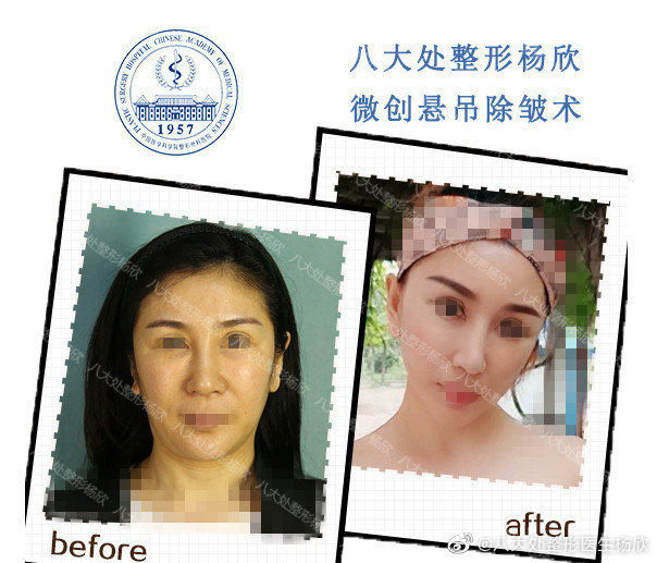 楊欣除皺術案例