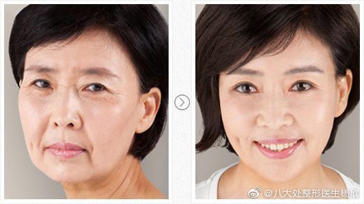 楊欣面部提升案例
