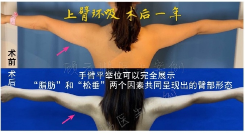 顧云鵬手臂吸脂案例