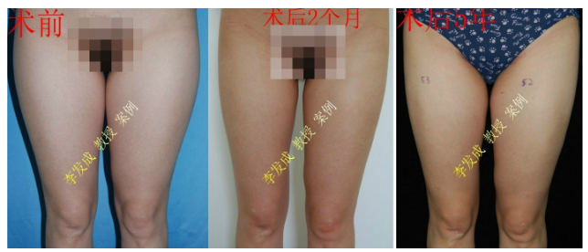 李發成大腿吸脂案例