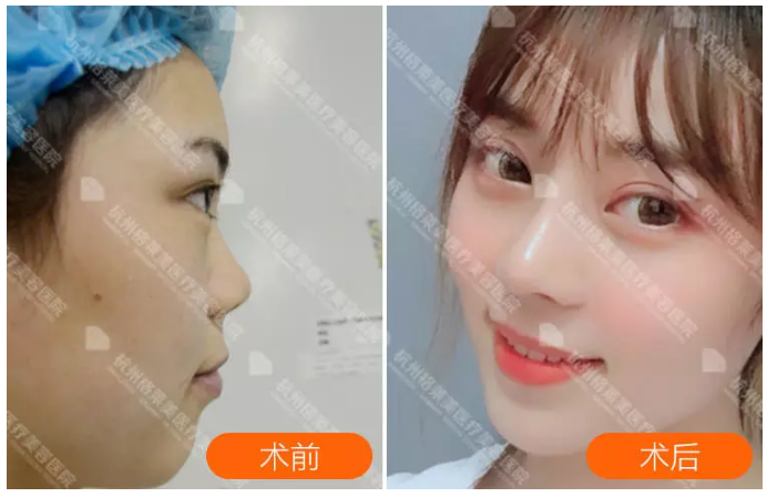 張龍鼻修復案例