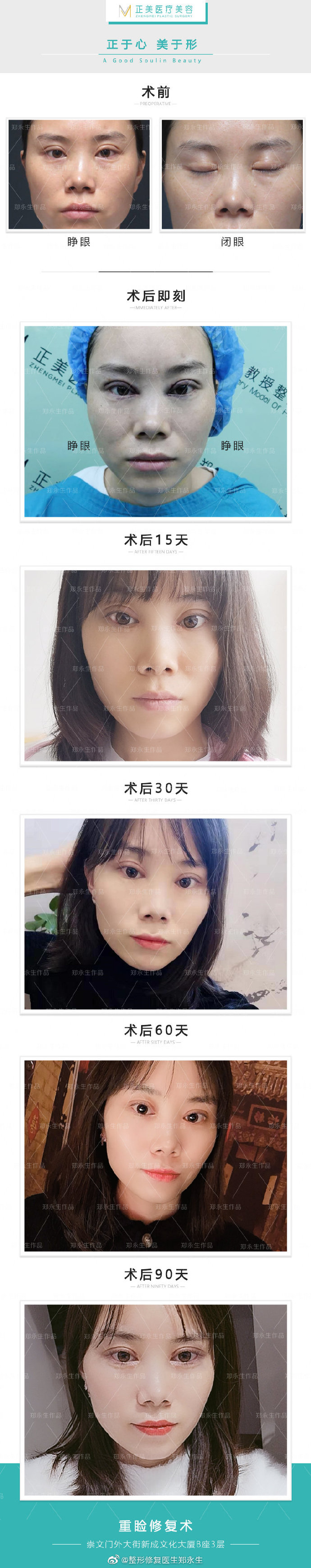 鄭永生雙眼皮修復(fù)案例