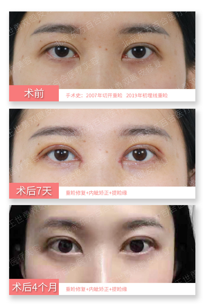 王世勇雙眼皮修復(fù)案例