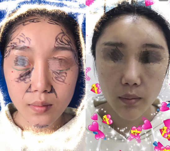 曹衛(wèi)剛脂肪填充案例