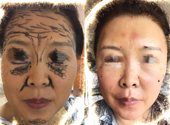 曹衛(wèi)剛脂肪填充案例