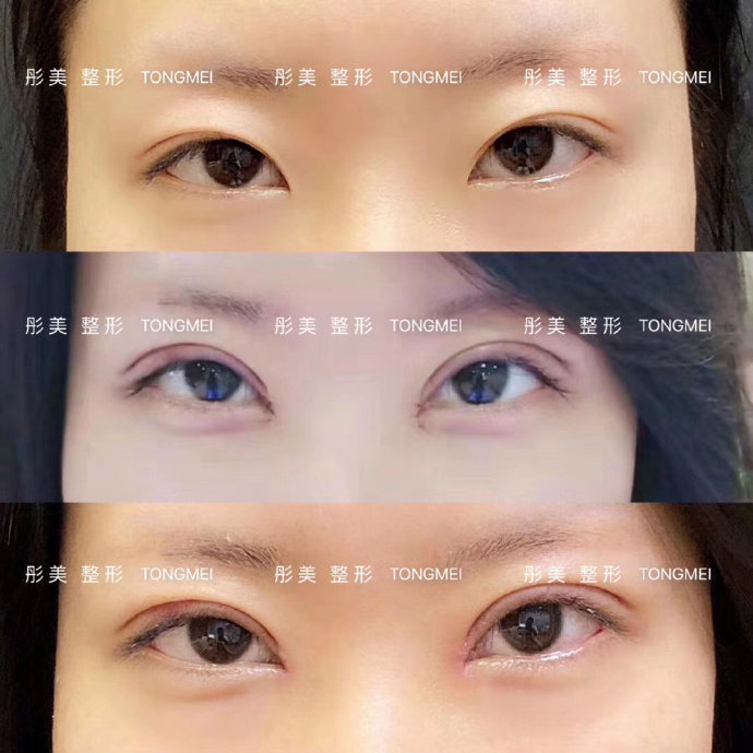 劉風卓雙眼皮修復案例