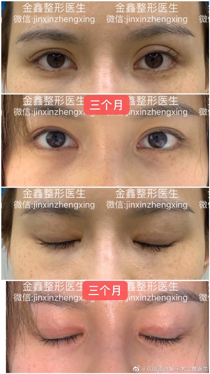 金鑫雙眼皮修復(fù)案例