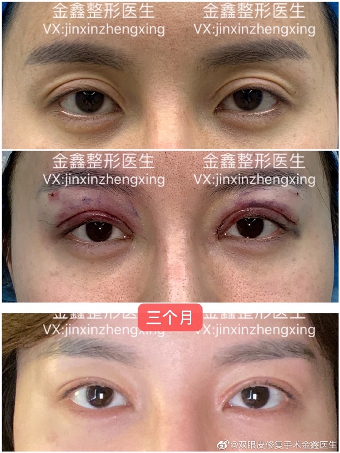 金鑫雙眼皮修復(fù)案例