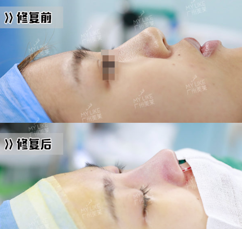 羅延平鼻綜合案例