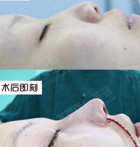 羅延平鼻綜合案例