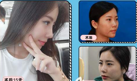 北京哪個醫生做鼻子最好？