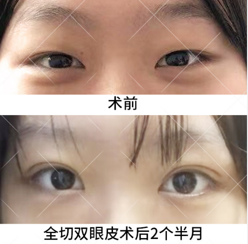 于曉波雙眼皮案例
