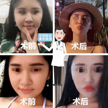 王軍鼻案例