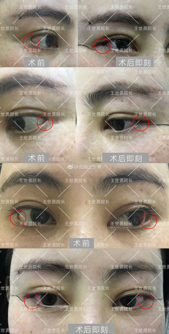 王世勇眼修復案例