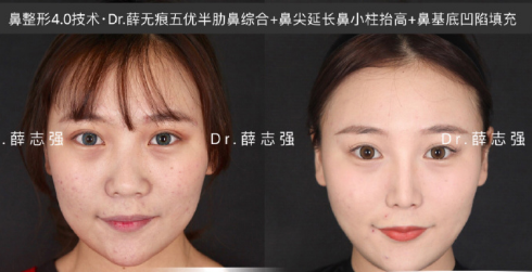 薛志強隆鼻案例