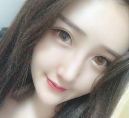 曾高鼻修復案例
